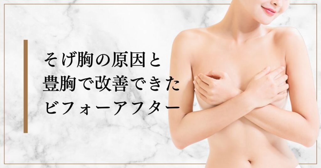 そげ胸の原因と豊胸で改善できたビフォーアフター