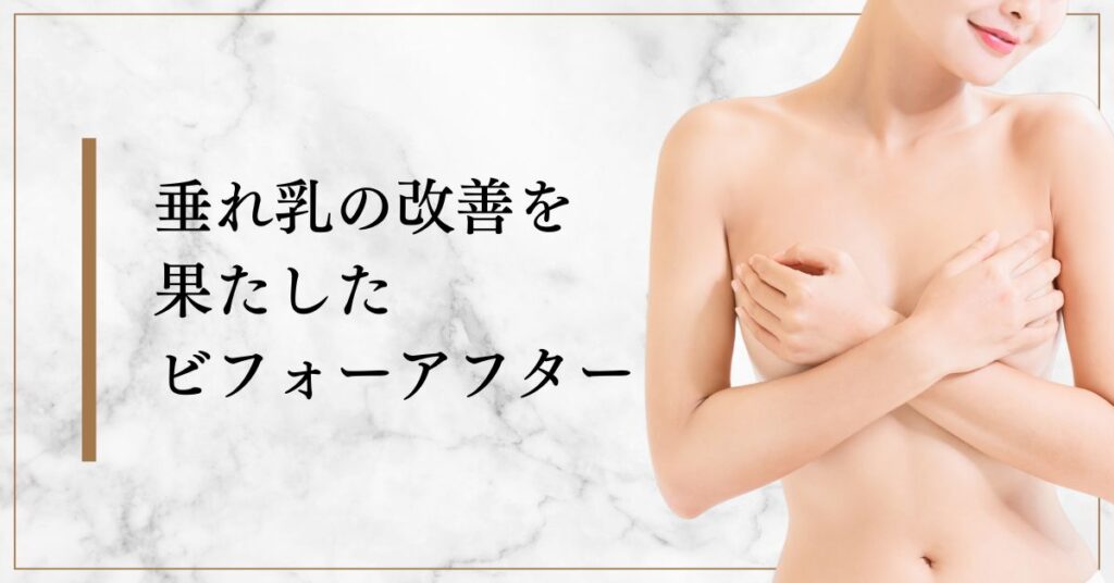 垂れ乳の改善を果たしたビフォーアフター