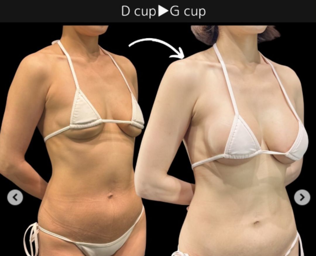 ヒアルロン酸豊胸からシリコンバッグへの移行症例1