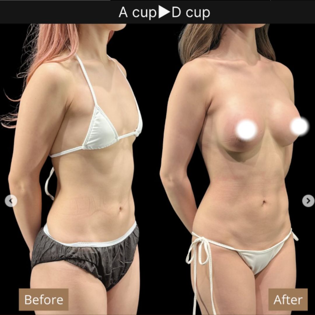 20代の豊胸症例⑤ 脂肪がなくても3カップUP