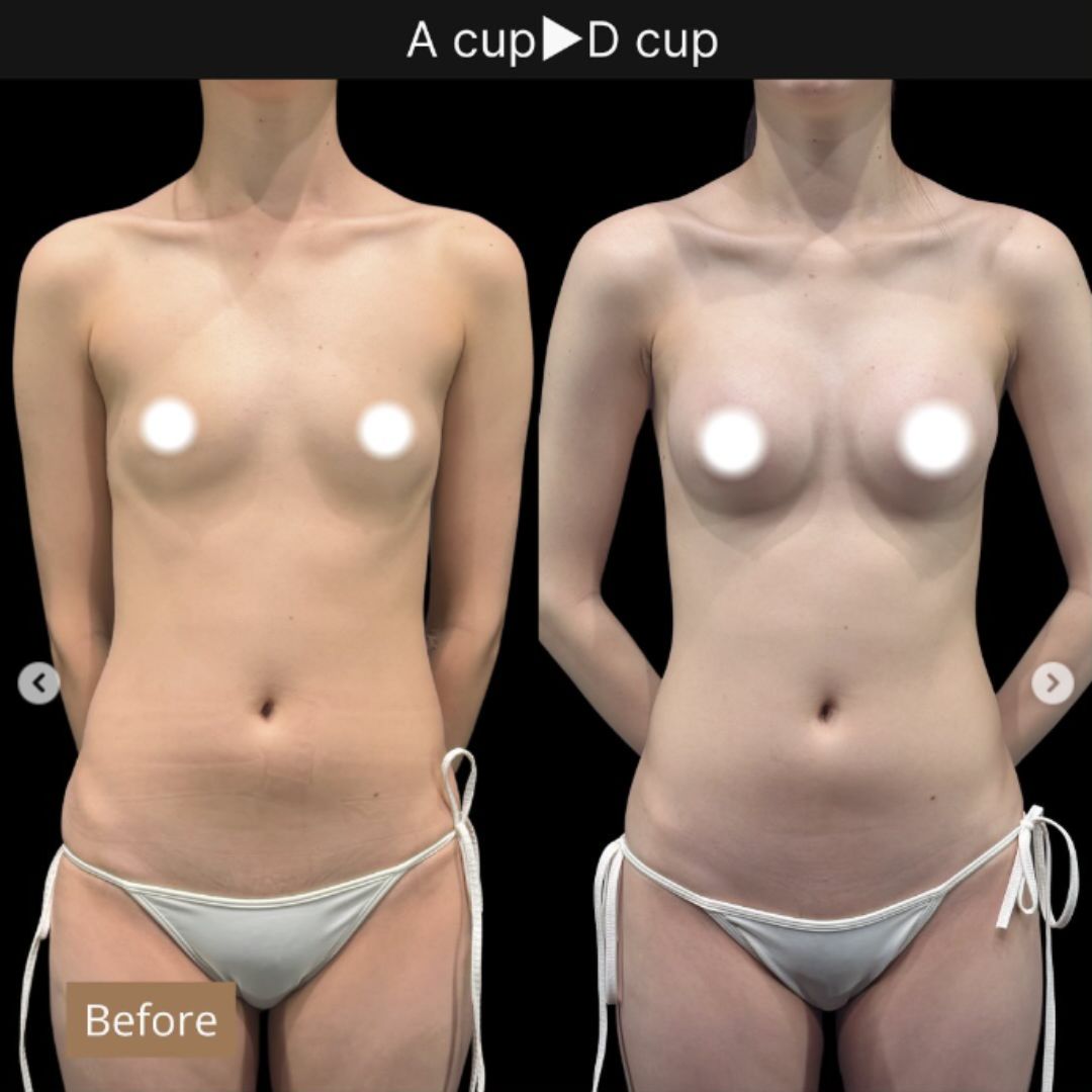 20代の豊胸症例6 脂肪がなくても3カップUP
