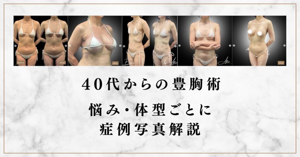 40代 豊胸 症例写真