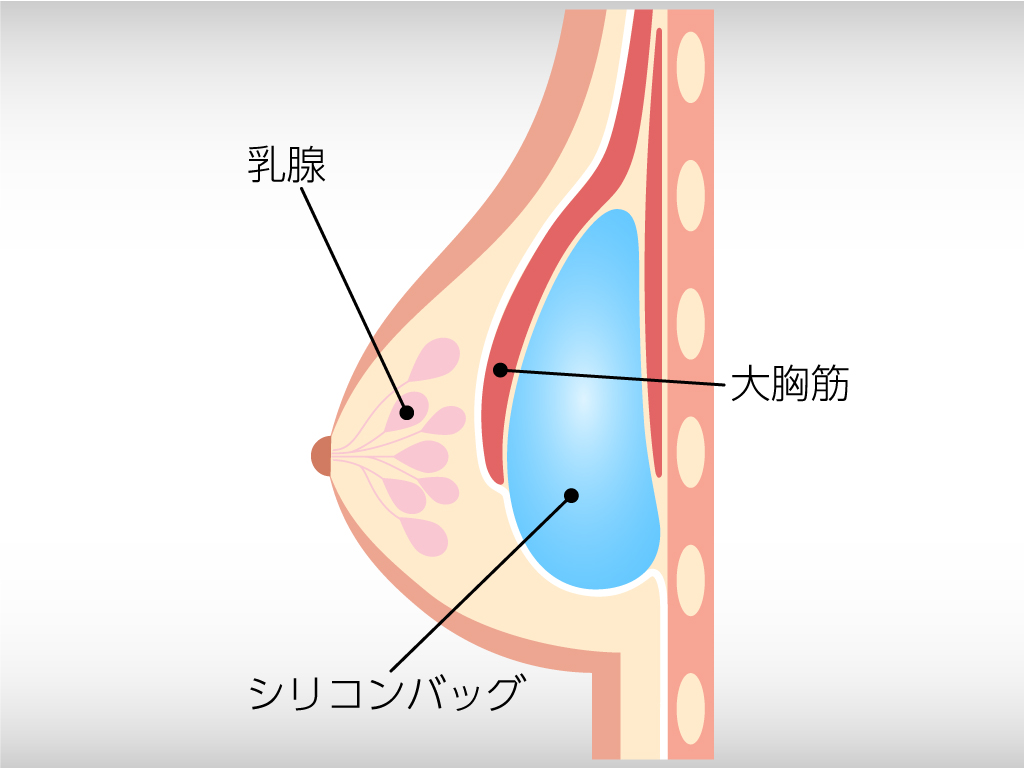デュアルプレーン法
