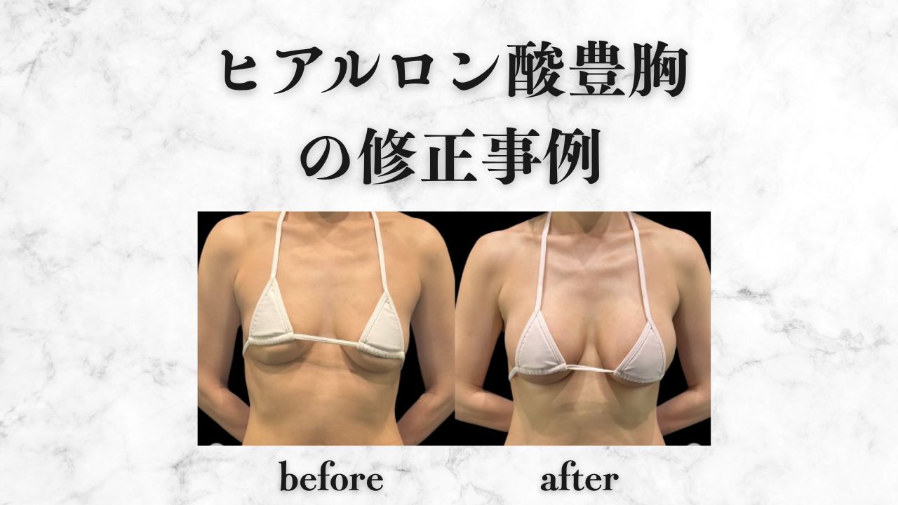 ヒアルロン酸豊胸ビフォーアフター