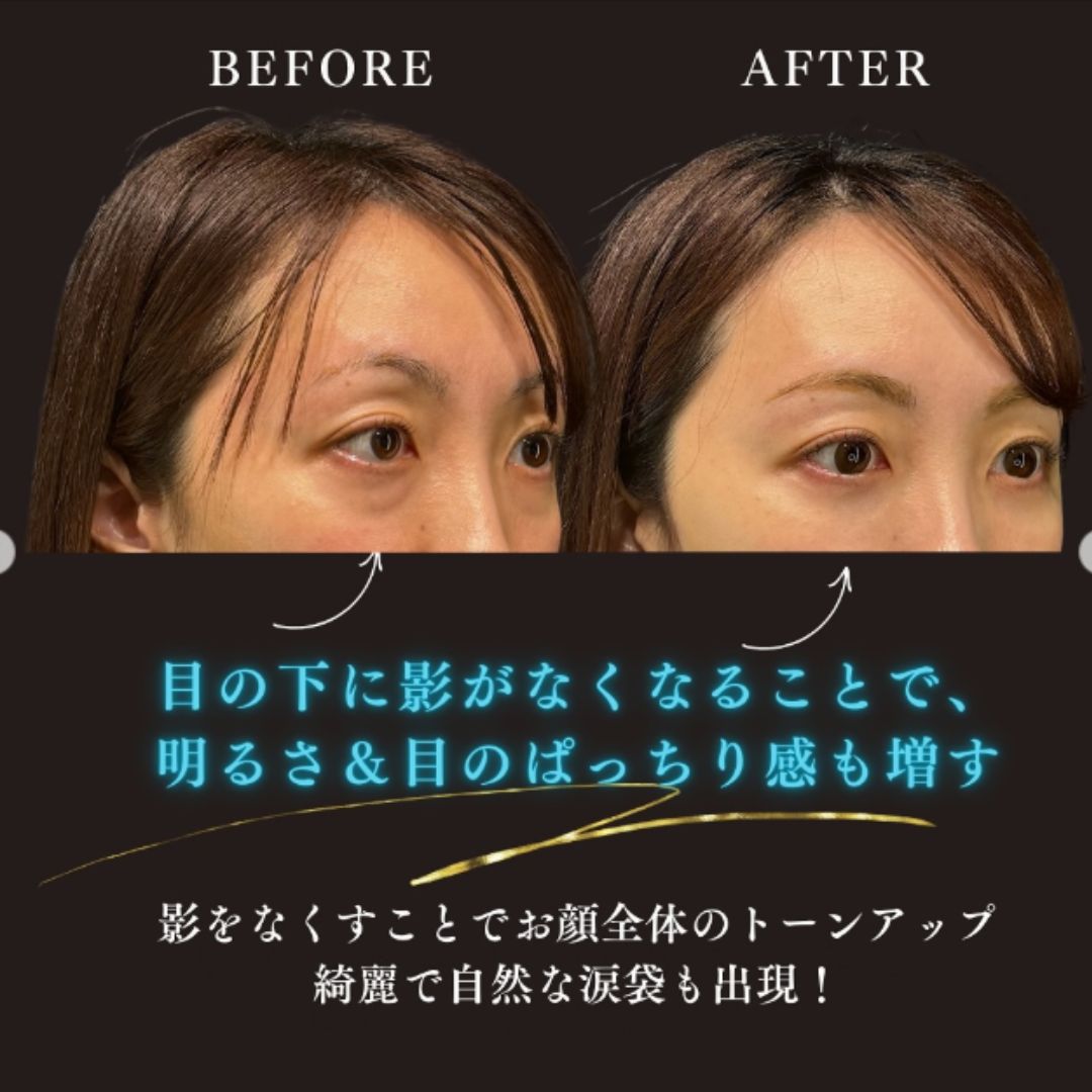切らないクマ取りの症例