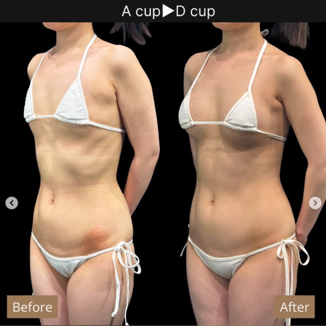 アクアフィリング症例3