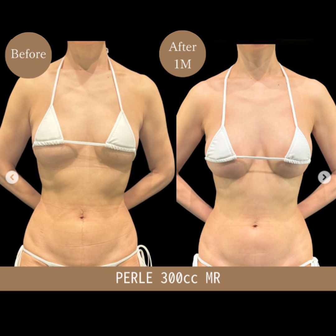 アクアフィリング除去 症例写真2