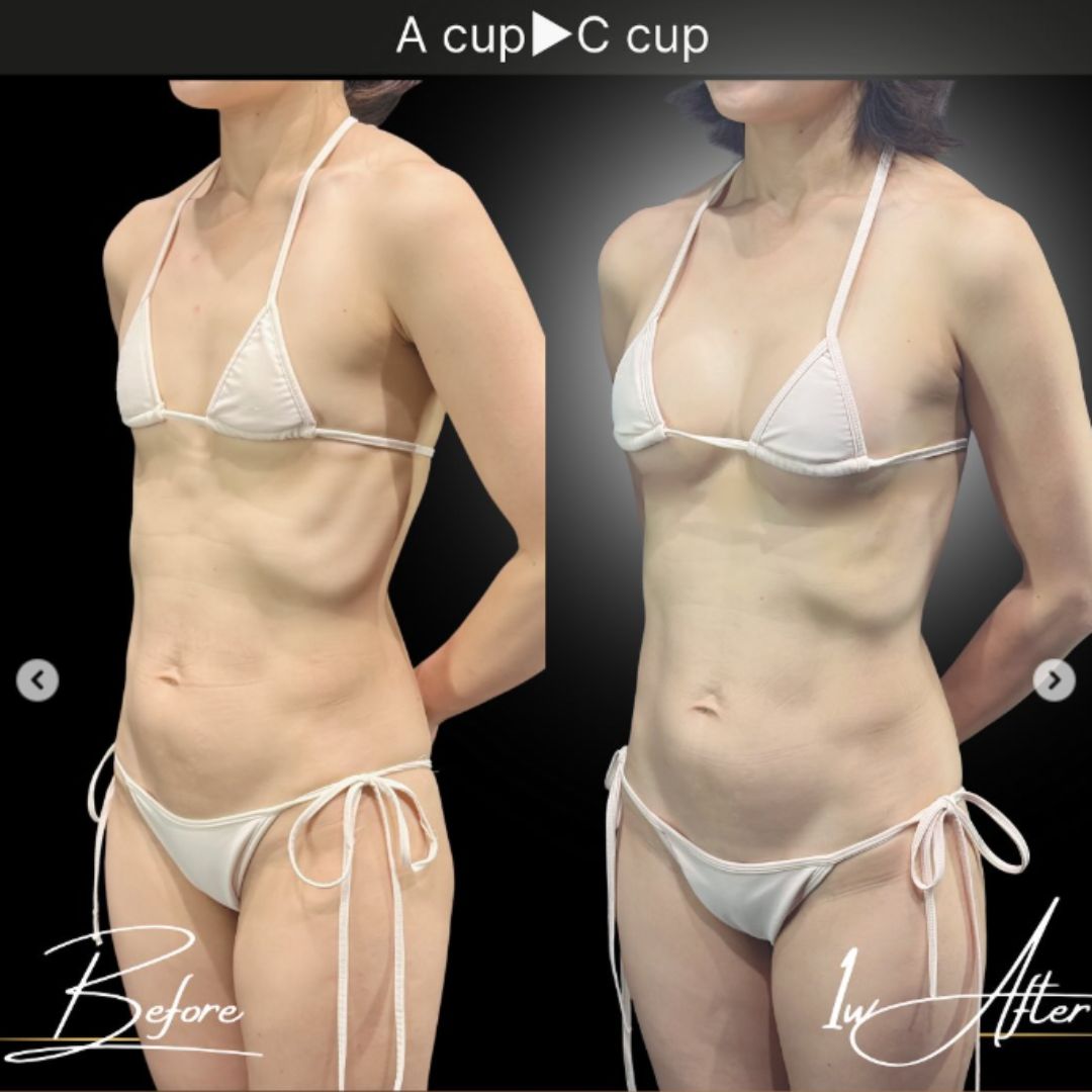 Aカップ豊胸症例（A→C）