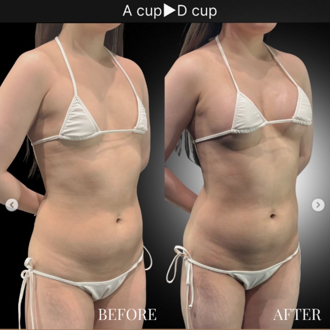 40代の豊胸症例① 授乳後にバストアップ