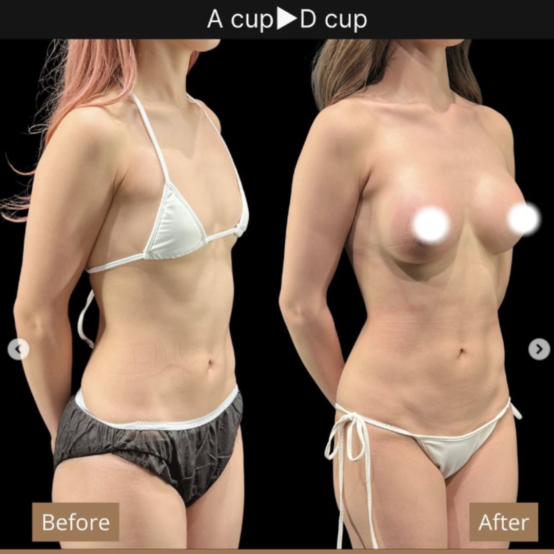 40代の豊胸症例① 授乳後にバストアップ