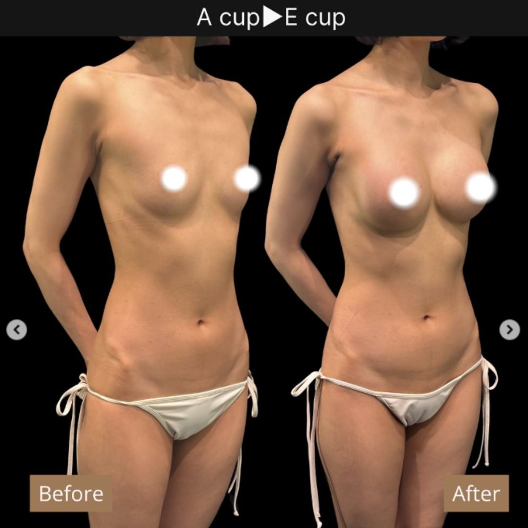 40代の豊胸症例① 授乳後にバストアップ