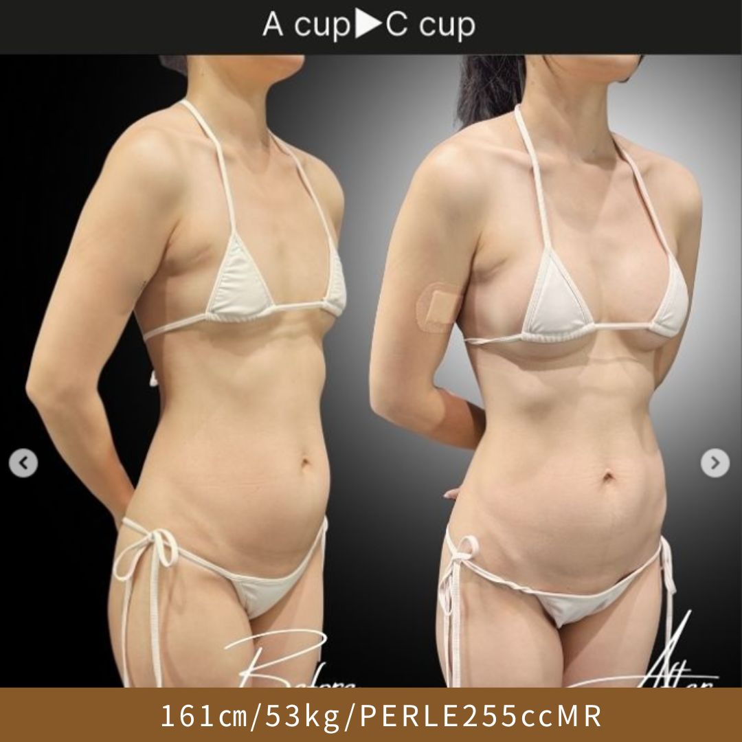 Aカップ豊胸症例（A→C）