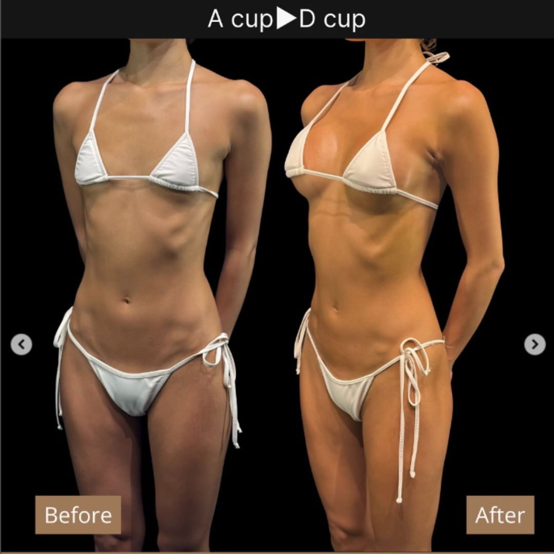 40代の豊胸症例① 授乳後にバストアップ