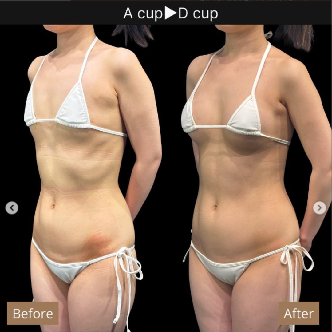 40代の豊胸症例① 授乳後にバストアップ