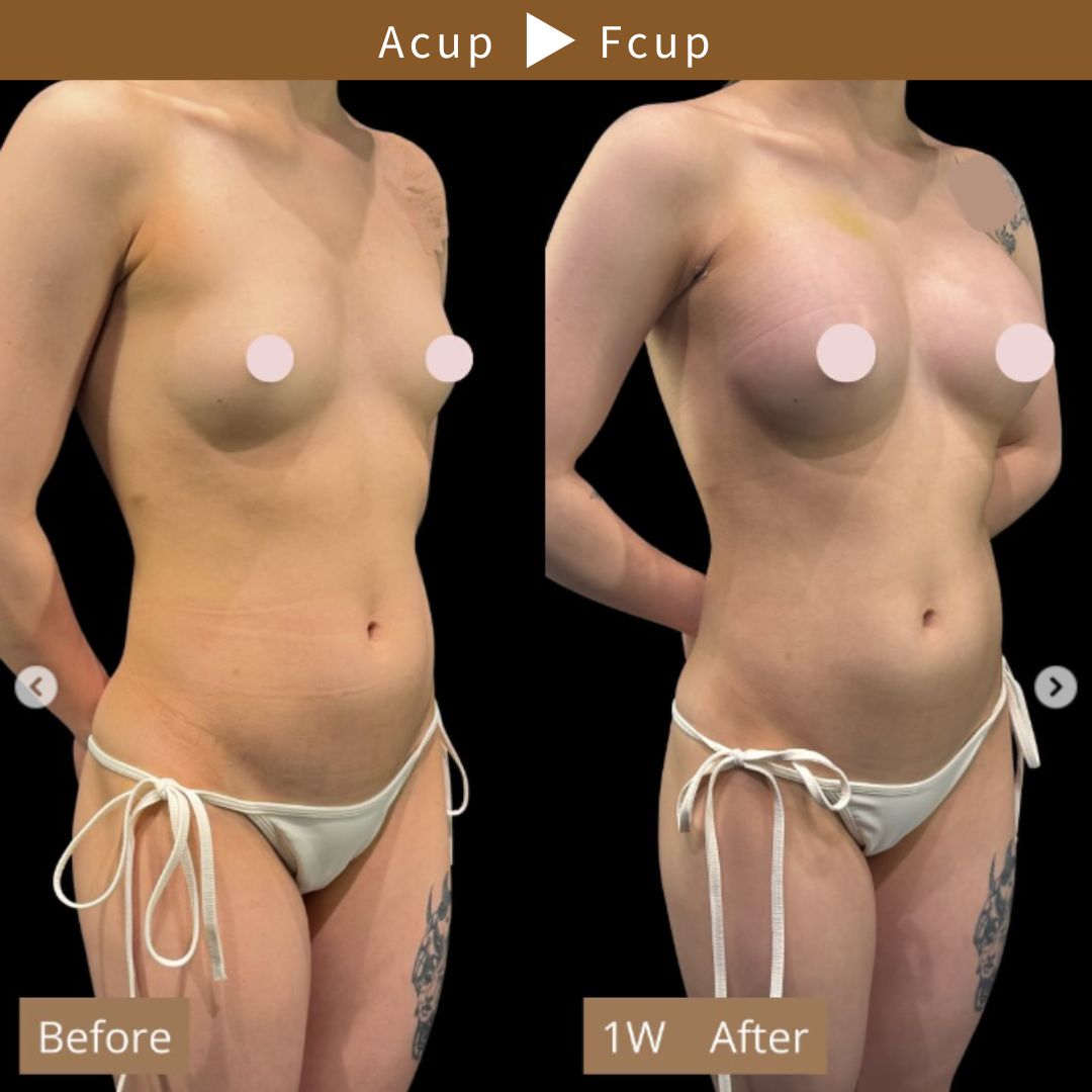 Aカップ豊胸症例（A→F）