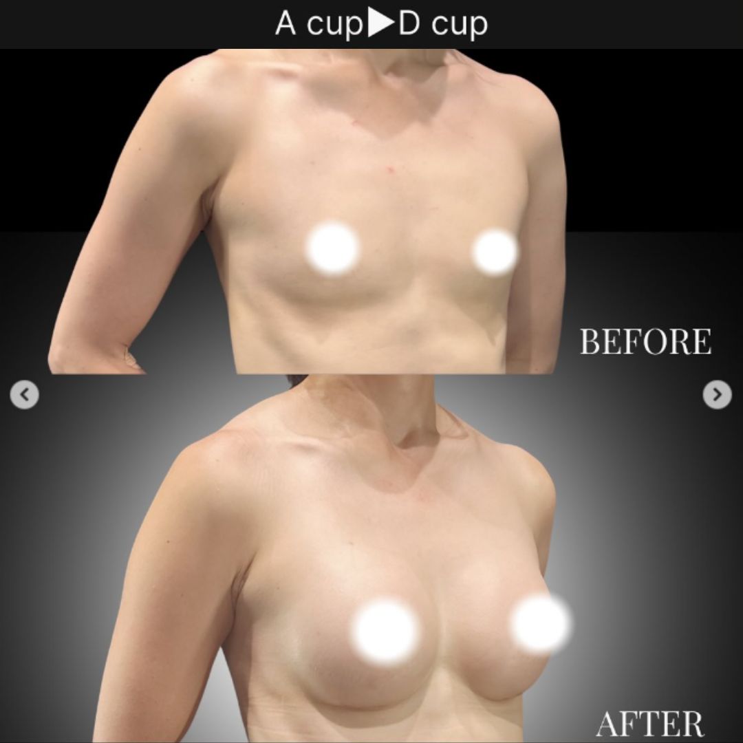 40代の豊胸症例① 授乳後にバストアップ