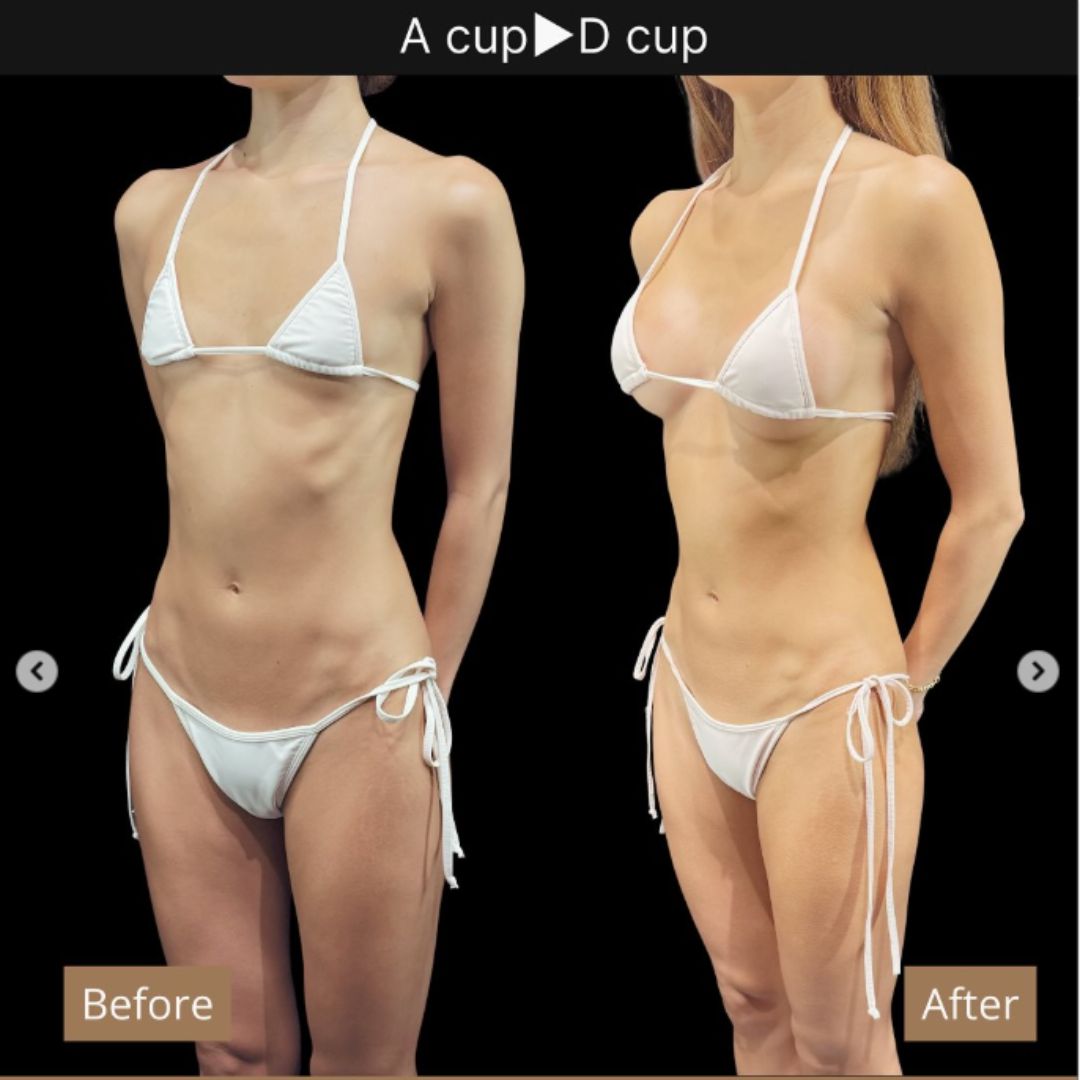 40代の豊胸症例① 授乳後にバストアップ