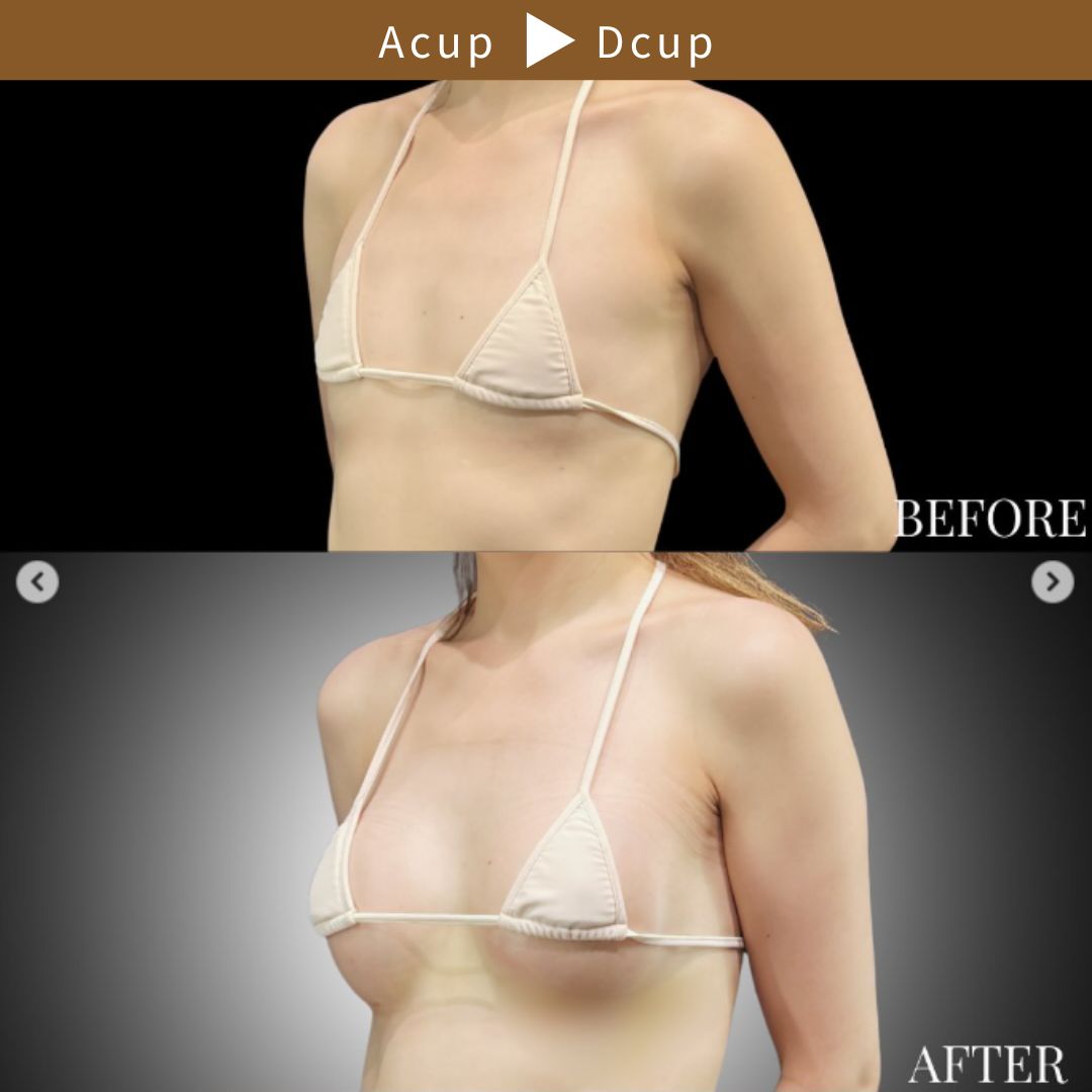 40代の豊胸症例① 授乳後にバストアップ