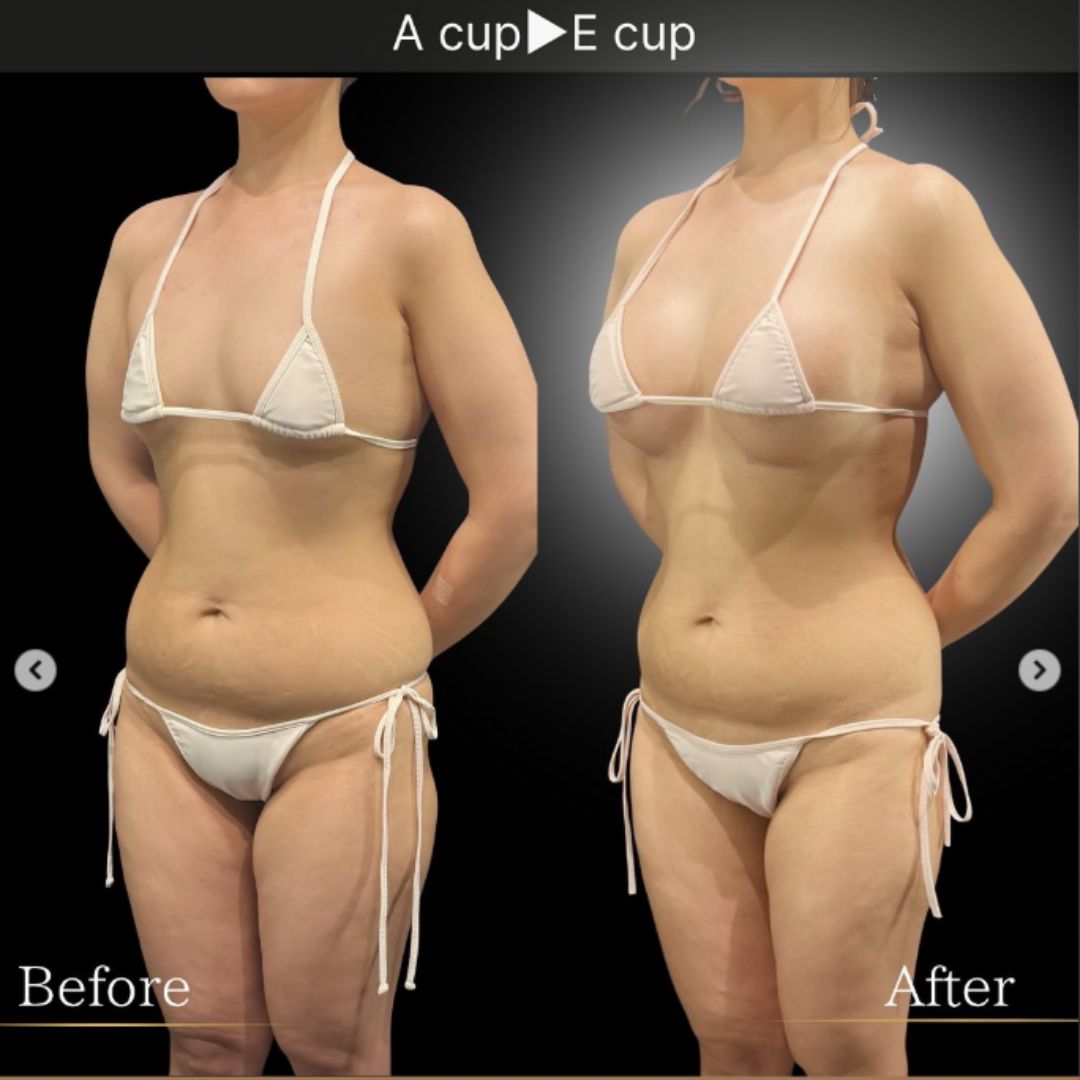 40代の豊胸症例① 授乳後にバストアップ