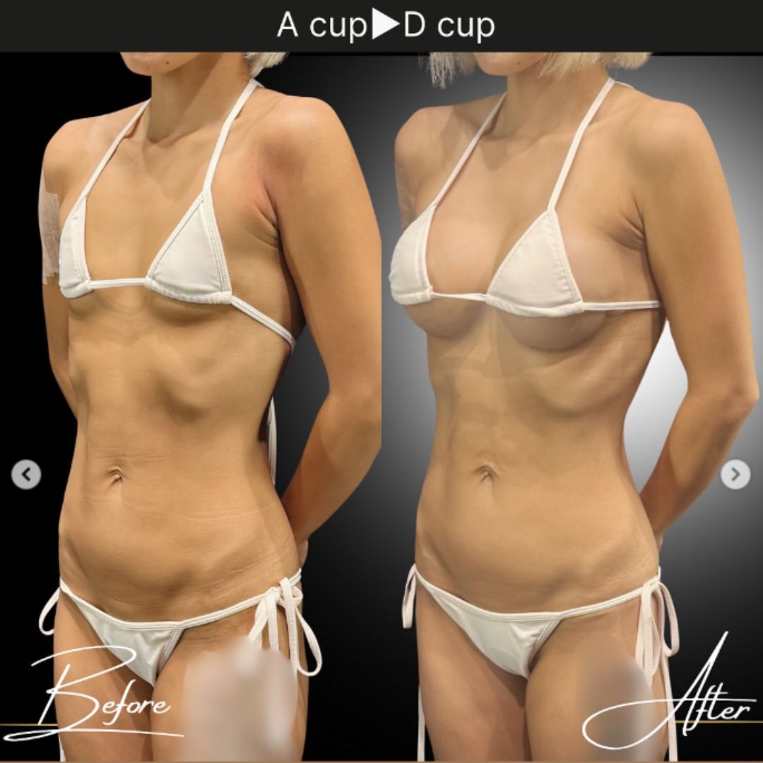 40代の豊胸症例① 授乳後にバストアップ