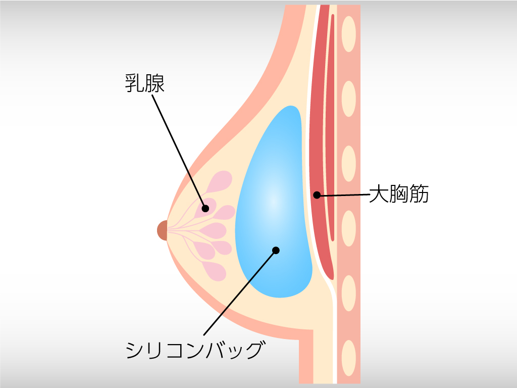 乳腺下法