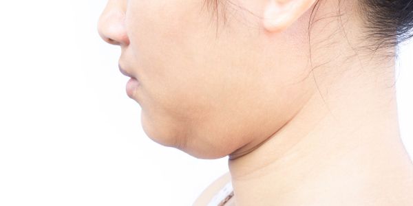 たるみや脂肪が進行している方