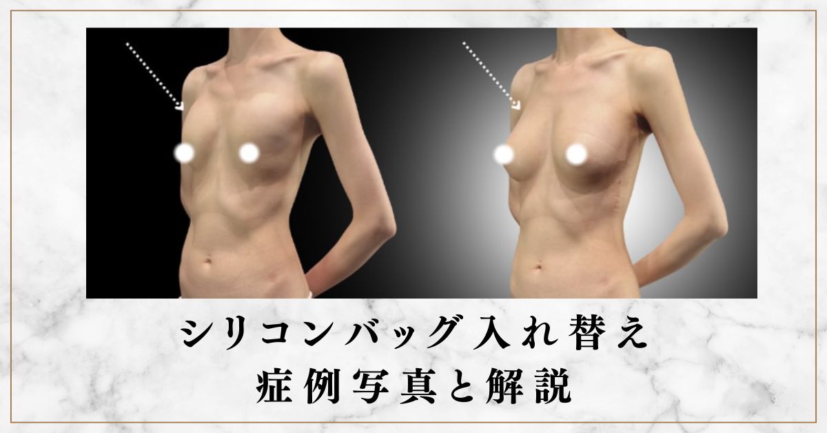 シリコンバッグ入れ替え交換 症例写真