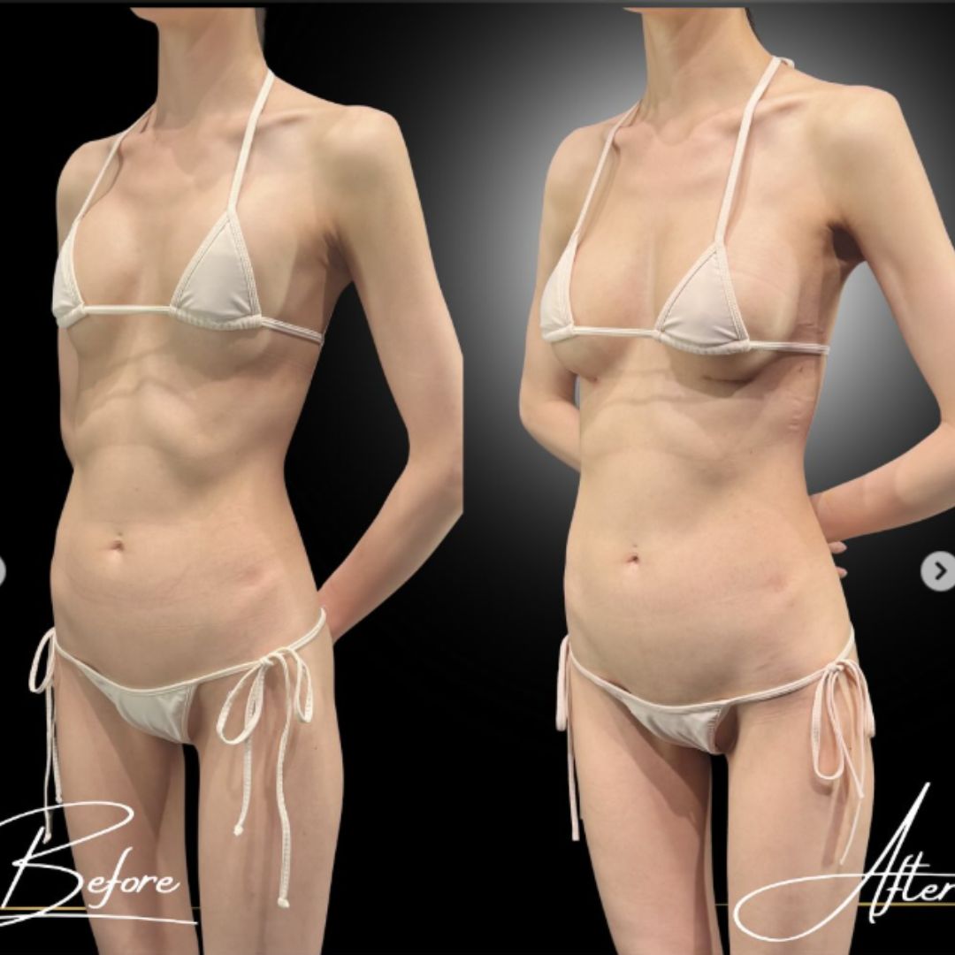 破損してしまったシリコンバッグの入れ替え症例