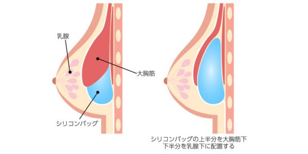 デュアルプレーン法