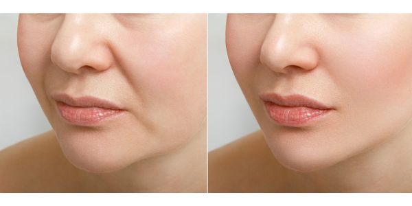 ハイフは徐々に、糸リフトはすぐに効果が出る