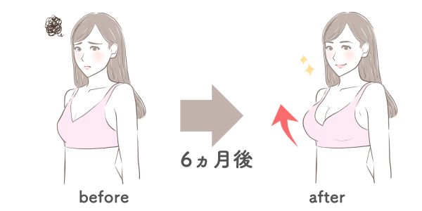 ハイブリッド豊胸のダウンタイム期間