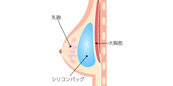 乳腺下法