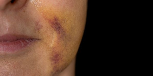 内出血・むくみ・しこりの長期化