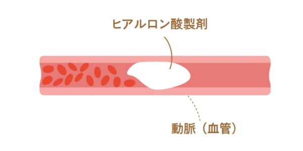 感染（血管閉塞・壊死）