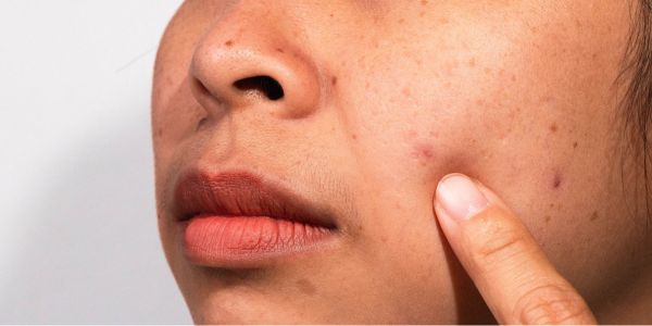 糸リフトの術後なかなか腫れがなかなか引かない場合