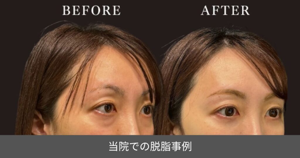 脱脂