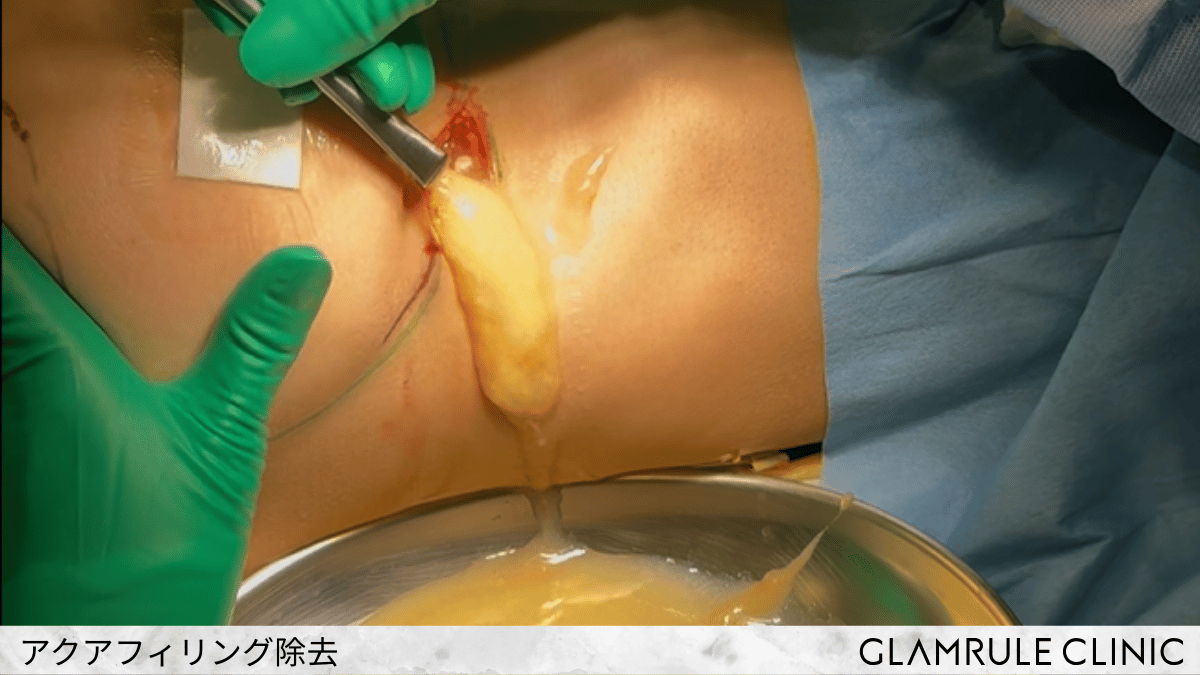 完全直視下法イメージ