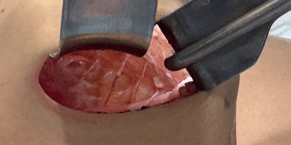 プロセス：剥がす