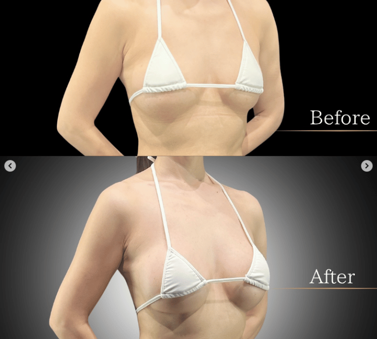 アクアフィリング除去 症例写真1