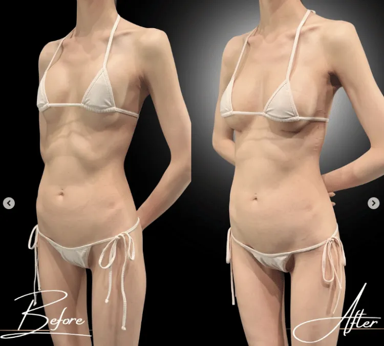 シリコンバッグ入れ替え症例1