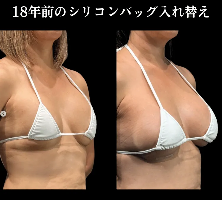 シリコンバッグ入れ替え症例3