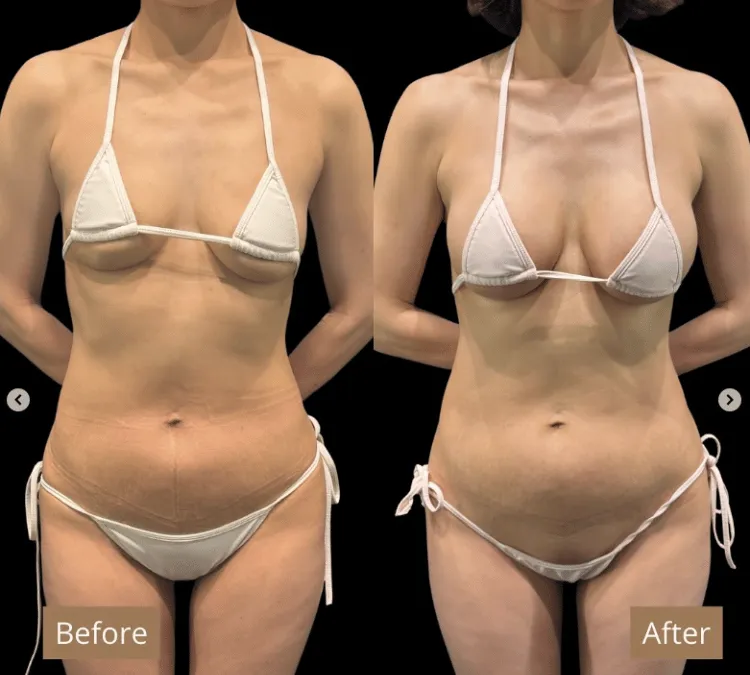 ヒアルロン酸豊胸症例3