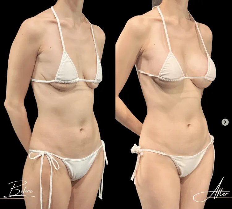 ヒアルロン酸豊胸症例4