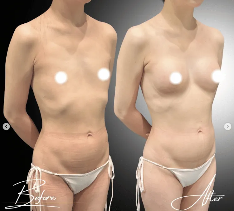 脂肪豊胸修正症例1
