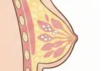 シコリができた