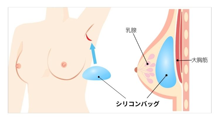 シリコンバッグ豊胸の解説図