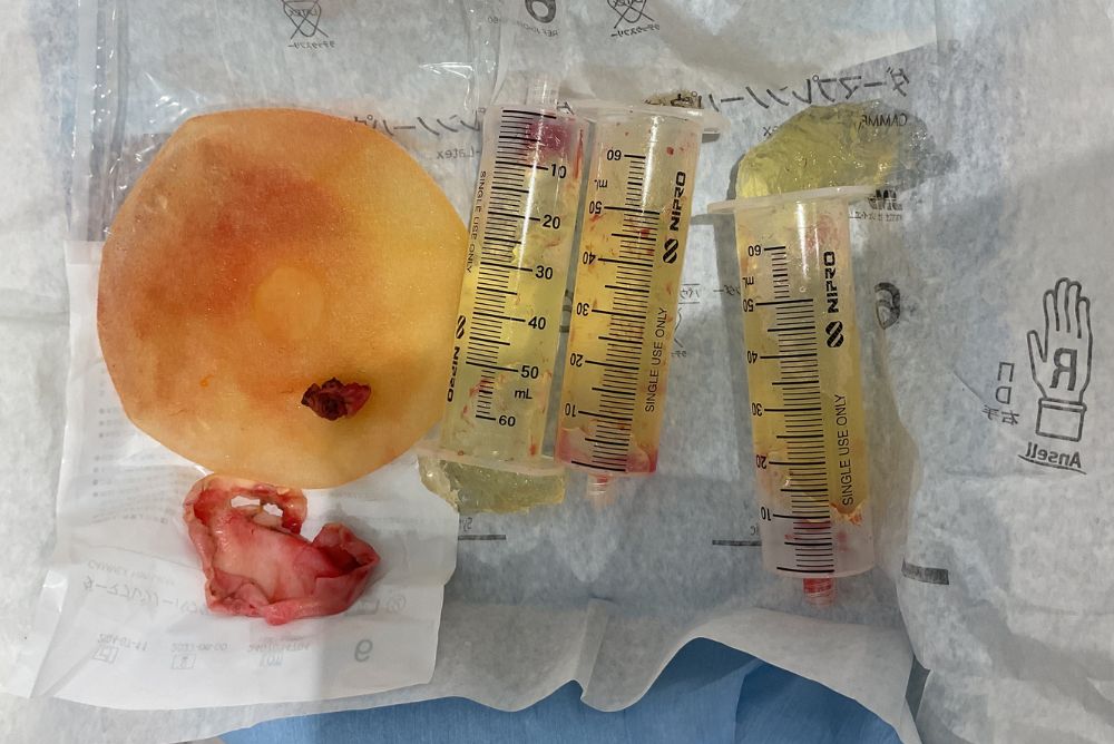 10年以上前のシリコンバッグの抜去･入れ替え