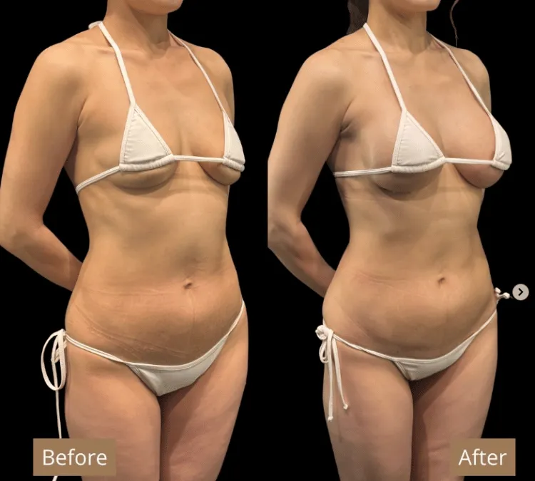 ヒアルロン酸豊胸症例5