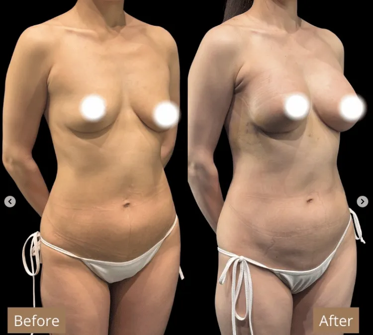 ヒアルロン酸豊胸症例6